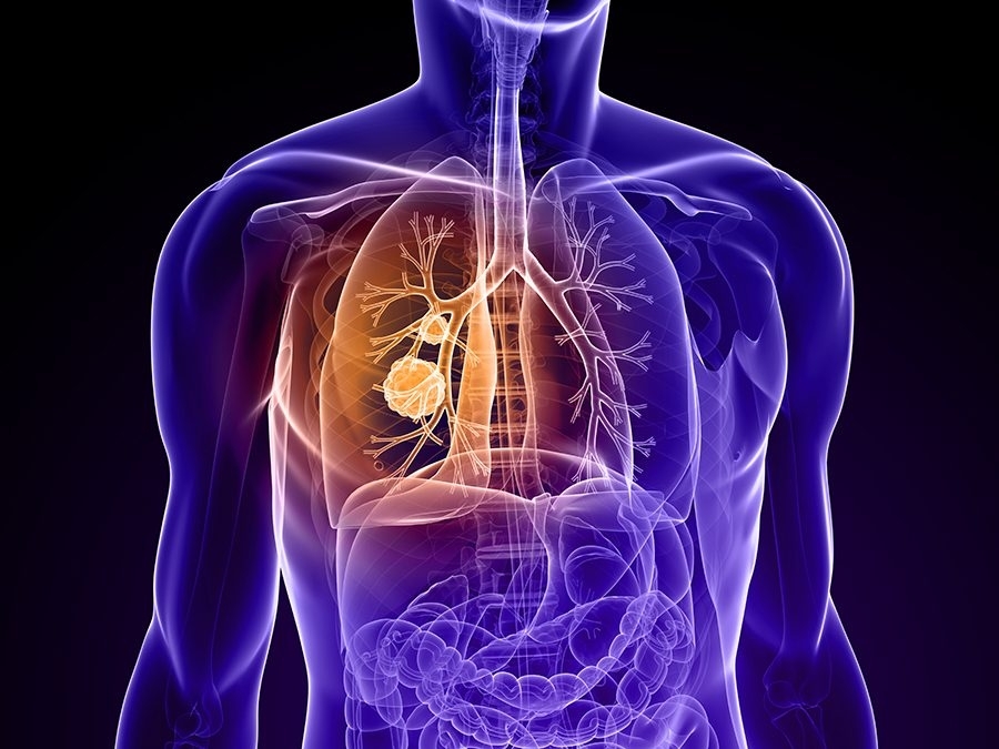New Approach to Fight Solid Tumors